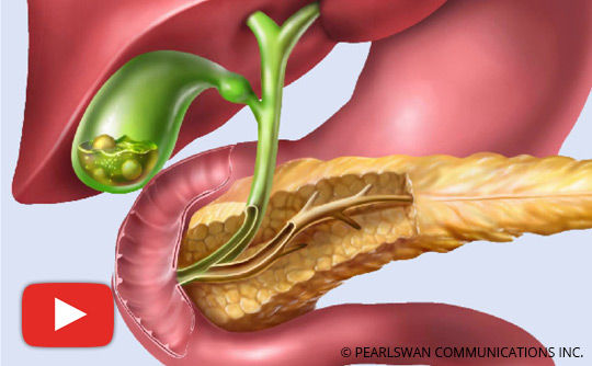 What You Should Know About Gallbladder Attack