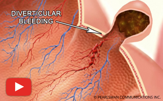 What You Should Know About Lower GI Bleed