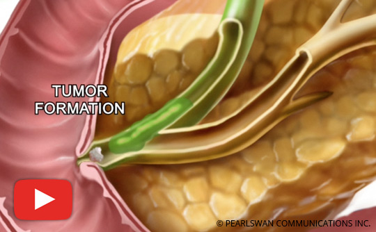 What You Should Know About Tumor Sphincter of Oddi