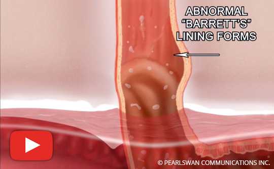 What You Should Know About Barrett's Esophagus