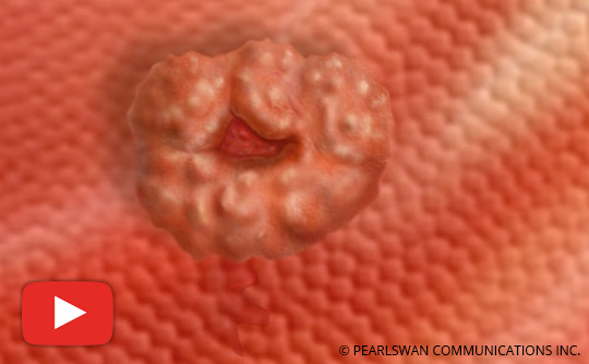 What You Should Know About Gallbladder Attack