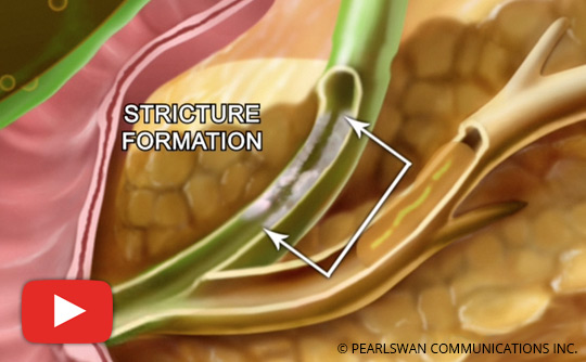 What You Should Know About Gallbladder Attack