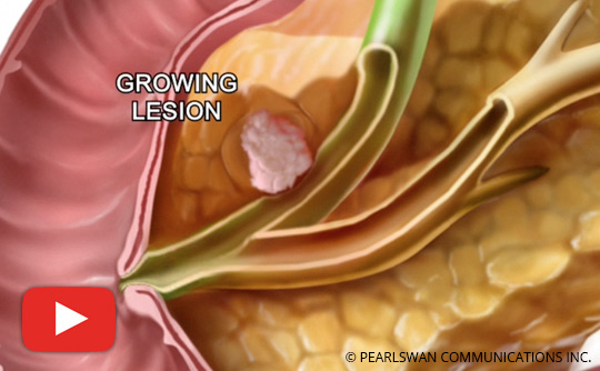 What You Should Know About Pancreatic Cancer